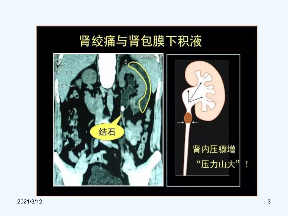 肾绞痛诊断和治疗的新概念课件.pptx_第3页