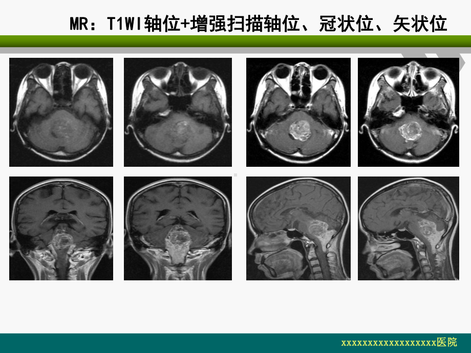 脑室内室管膜瘤的影像诊断及鉴别-课件.ppt_第3页