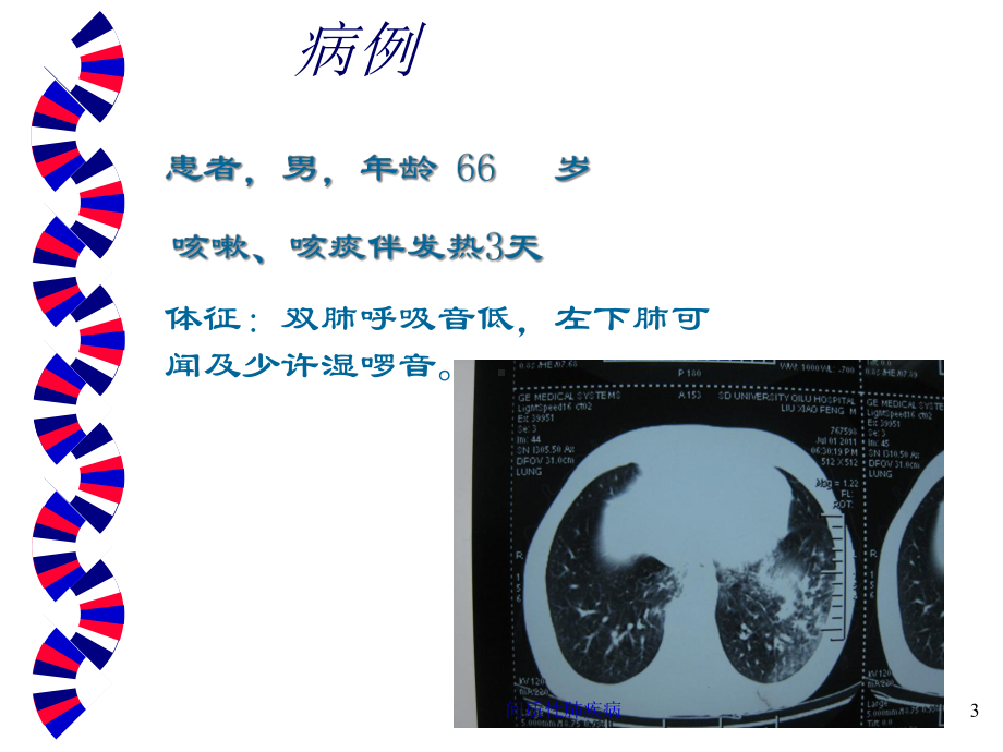 间质性肺疾病培训课件.ppt_第3页