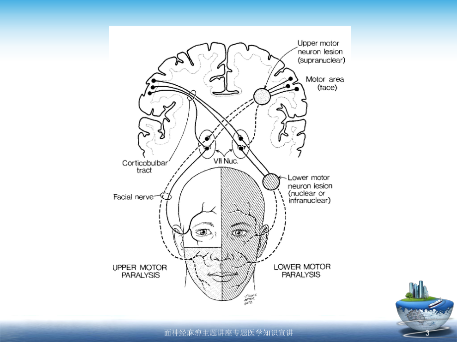 面神经麻痹主题讲座专题医学知识宣讲培训课件.ppt_第3页
