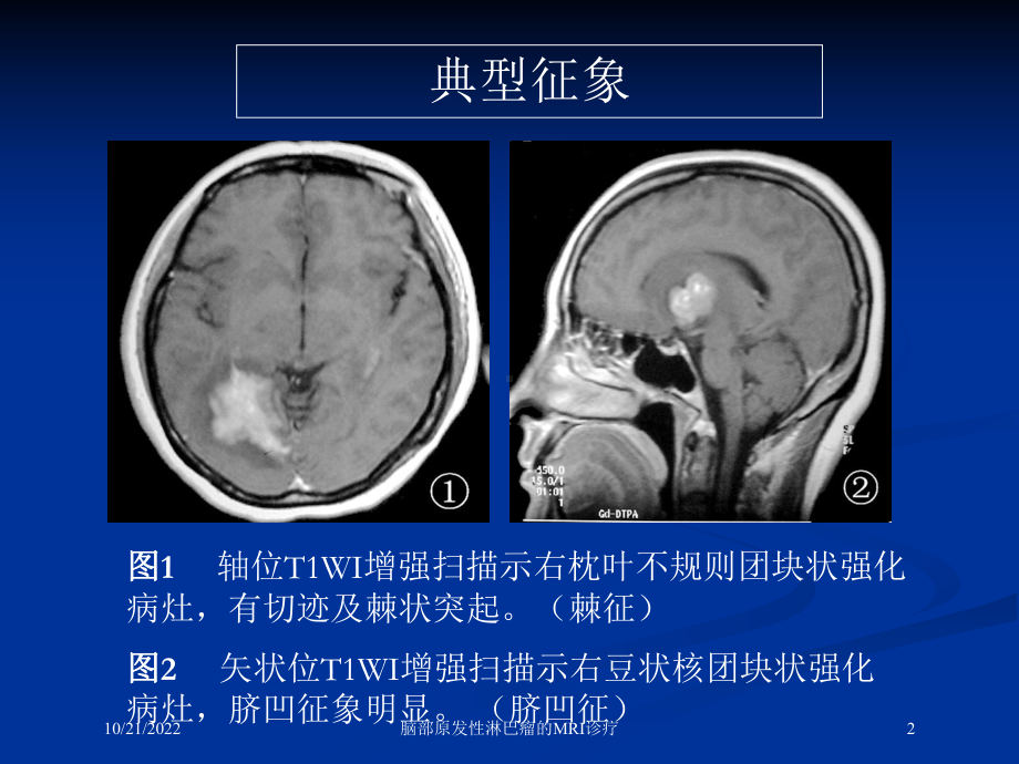 脑部原发性淋巴瘤的MRI诊疗培训课件.ppt_第2页