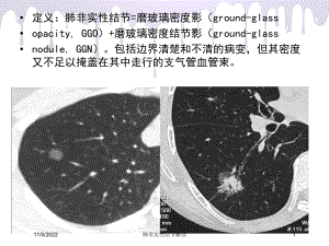 肺非实性结节解读培训课件.ppt