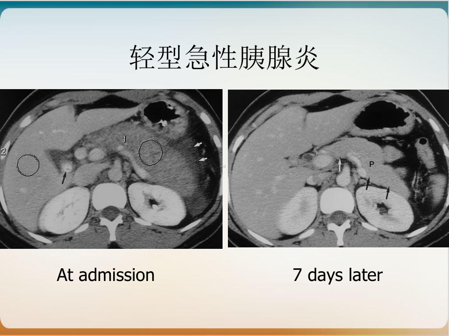 重症急性胰腺炎的营养策略培训课程课件.ppt_第2页