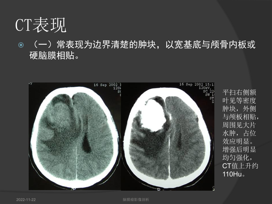 脑膜瘤影像学表现课件2.ppt_第3页