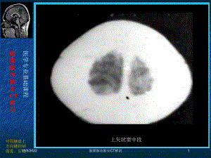 脑膜脑池脑室CT解剖培训课件.ppt