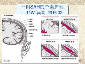 蛛网膜下腔出血的个案护理最终参考课件.ppt