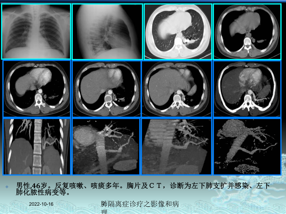 肺隔离症诊疗之影像和病理培训课件.ppt_第2页