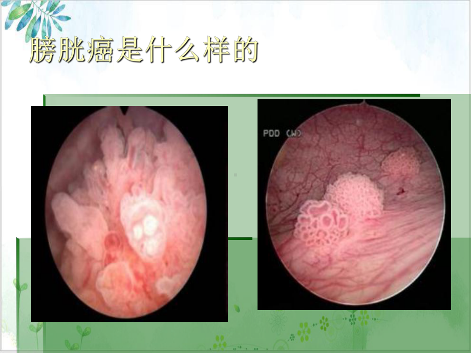 非肌层浸润性膀胱癌的诊断治疗课件.pptx_第1页