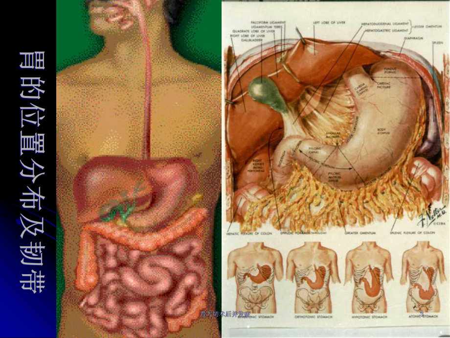胃大切术后并发症培训课件.ppt_第3页