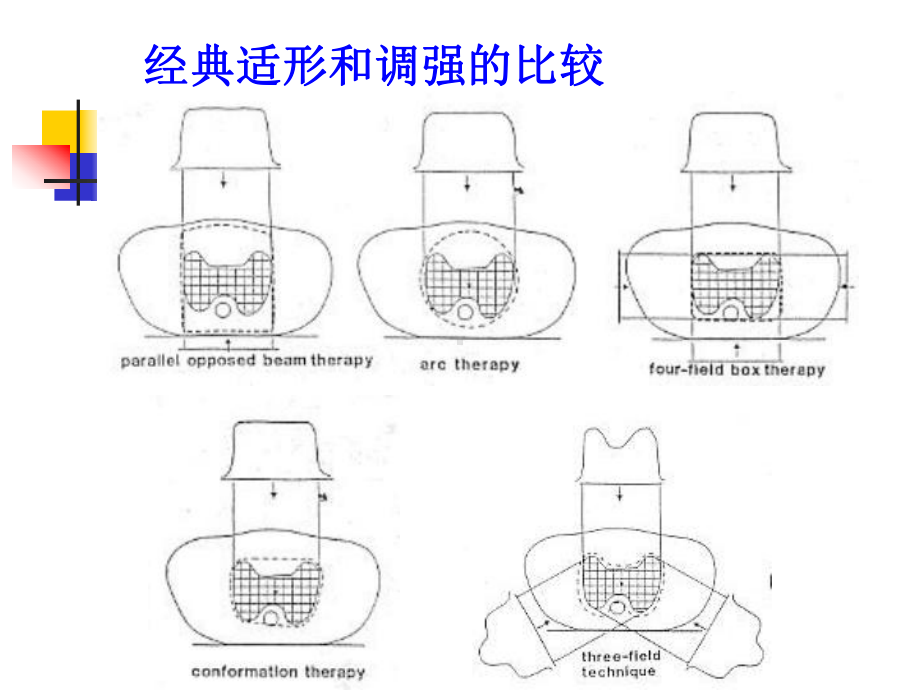 调强放射治疗汇编课件.ppt_第3页