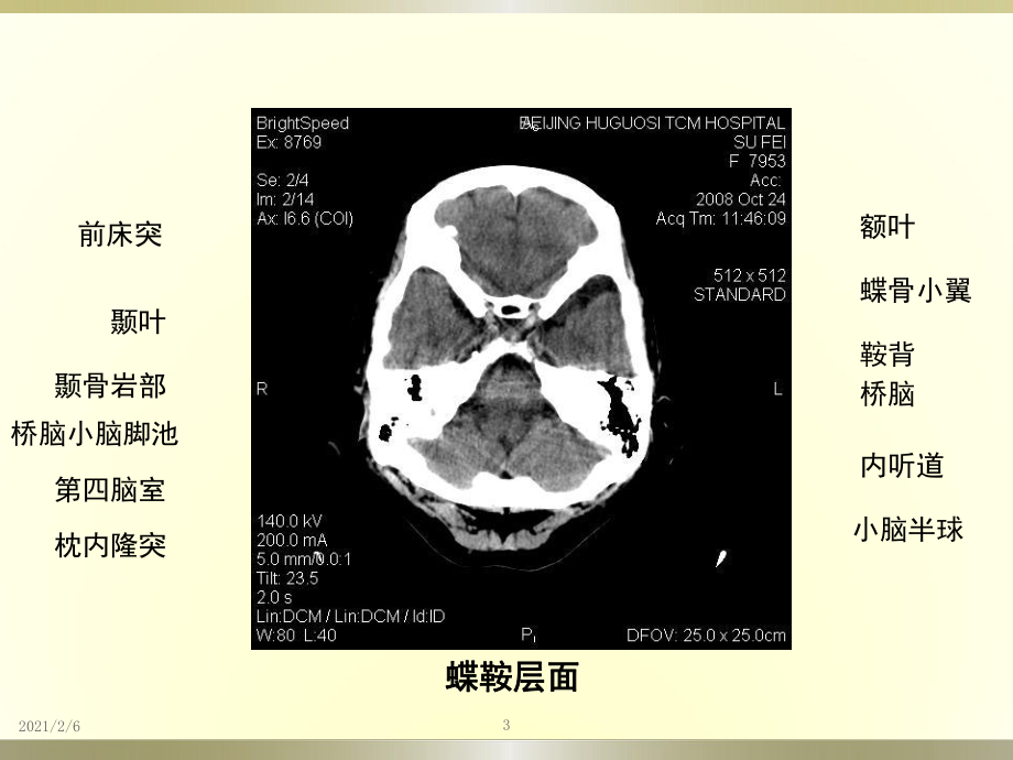 脑血管病变影像诊断级鉴别诊断课件.pptx_第3页