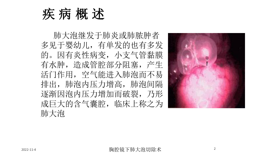 胸腔镜下肺大泡切除术培训课件.ppt_第2页