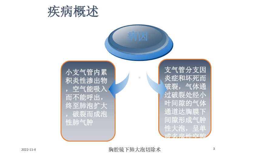 胸腔镜下肺大泡切除术培训课件.ppt_第3页