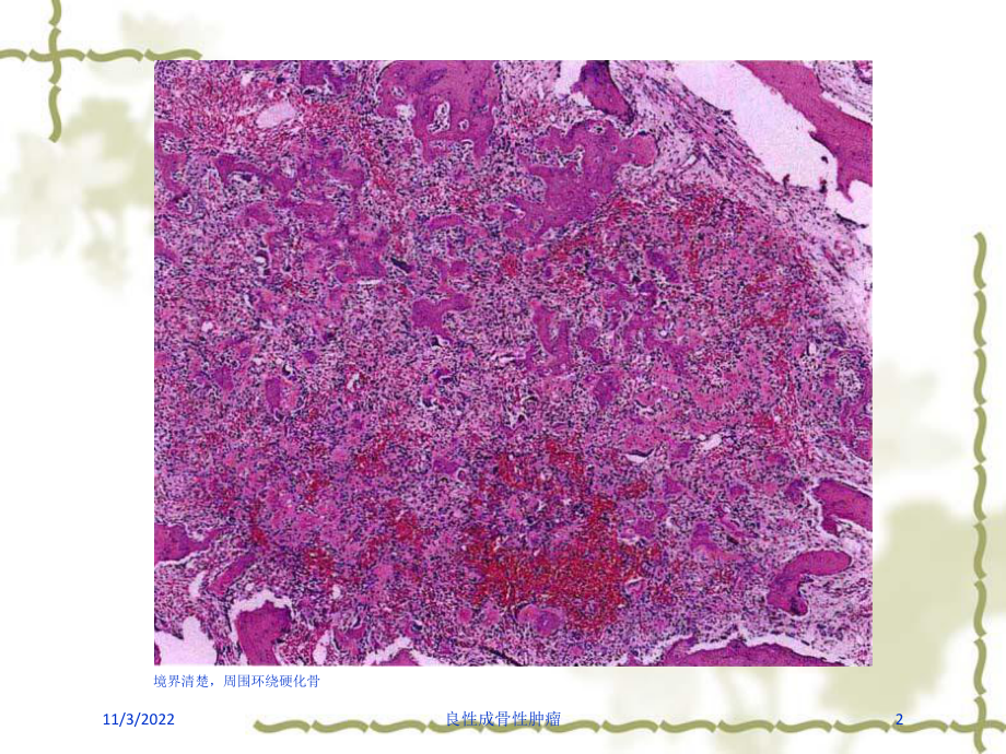 良性成骨性肿瘤培训课件.ppt_第2页