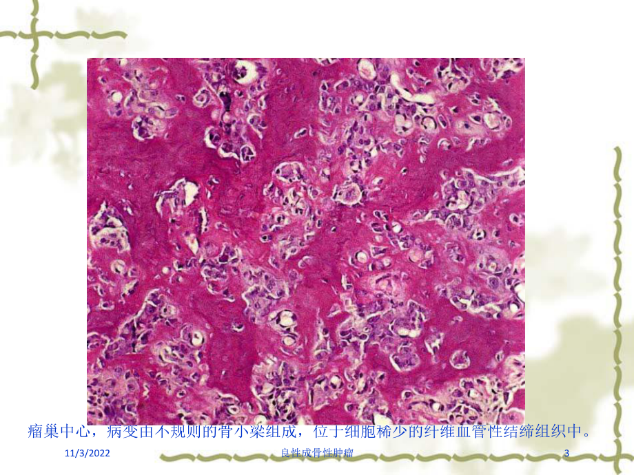 良性成骨性肿瘤培训课件.ppt_第3页