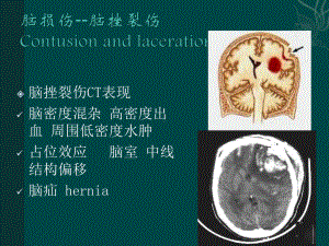 常见神经系统疾病影像学表现讲解课件.pptx