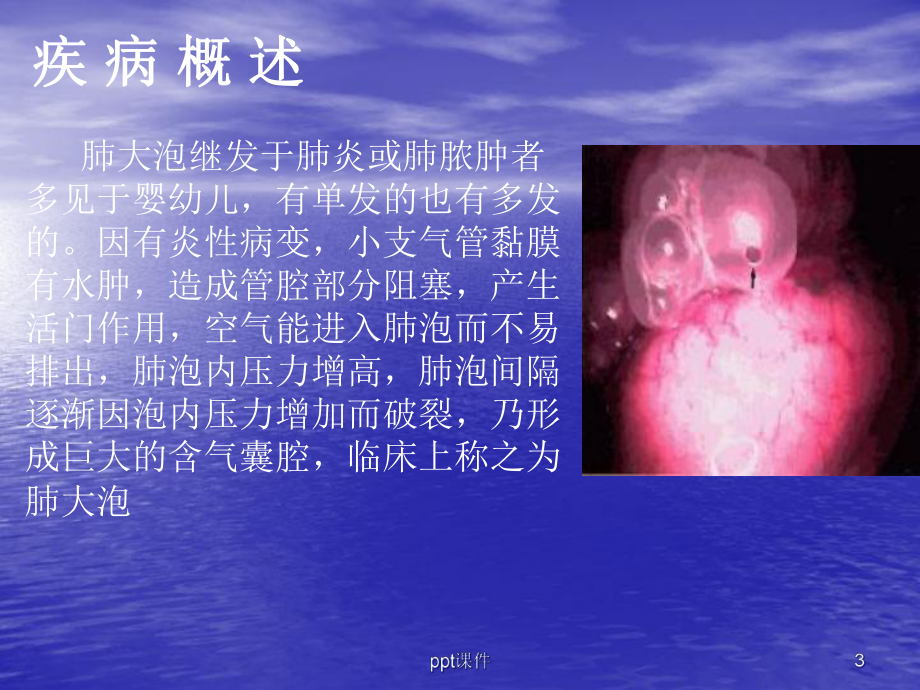 胸腔镜肺大疱切除-课件.ppt_第3页