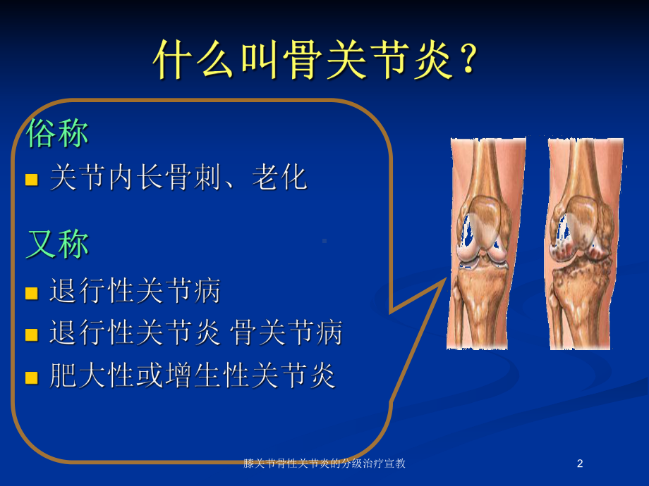 膝关节骨性关节炎的分级治疗宣教培训课件.ppt_第2页