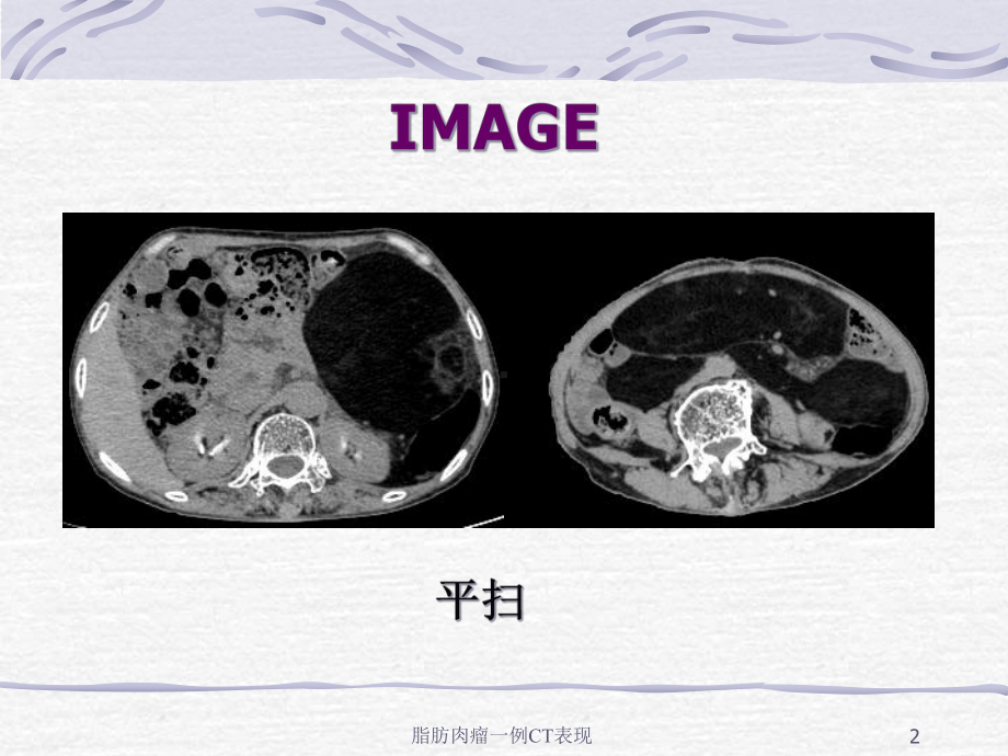 脂肪肉瘤一例CT表现培训课件.ppt_第2页