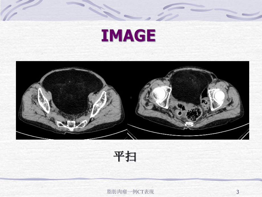 脂肪肉瘤一例CT表现培训课件.ppt_第3页