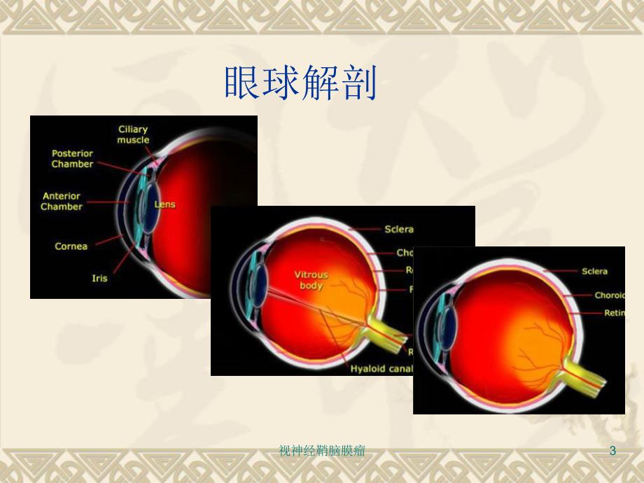 视神经鞘脑膜瘤培训课件.ppt_第3页