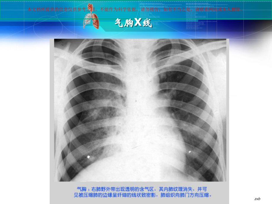 自发性气胸患者的护理专题讲座培训课件.ppt_第2页