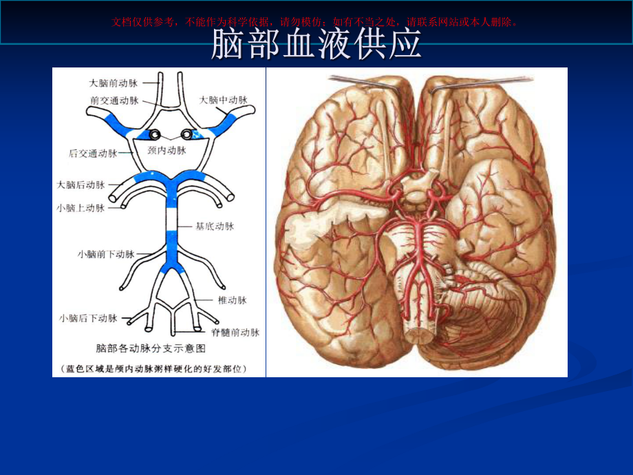 脑血管疾病专题知识讲座课件.ppt_第3页