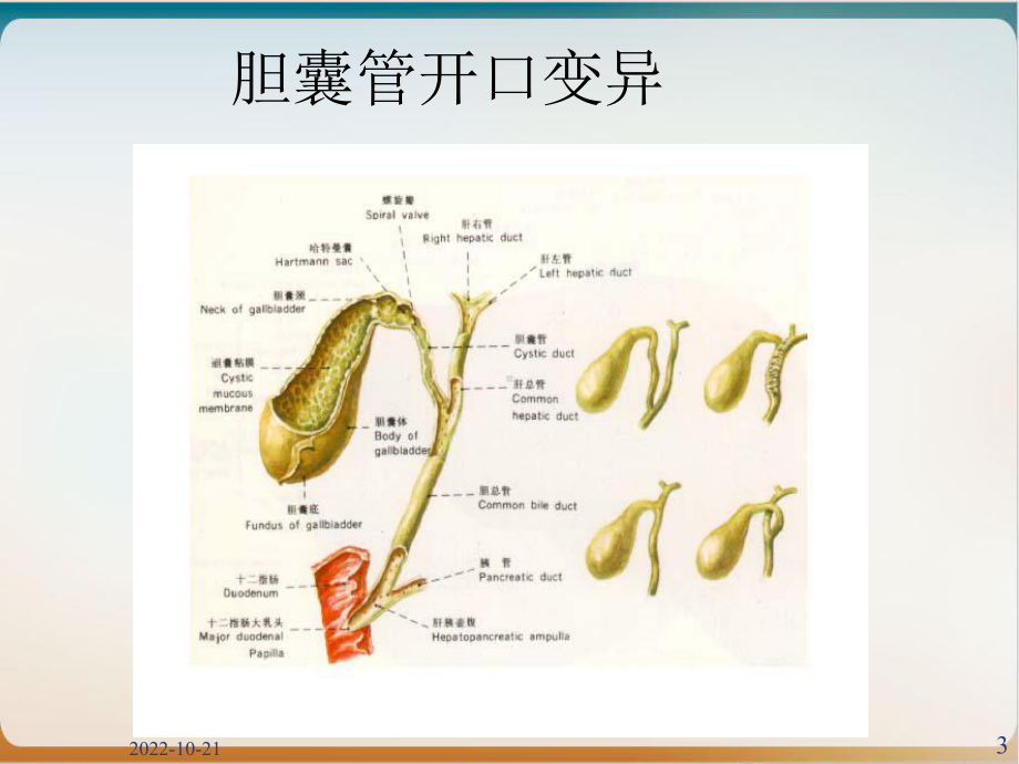 胆囊结石伴胆囊炎课件.ppt_第3页