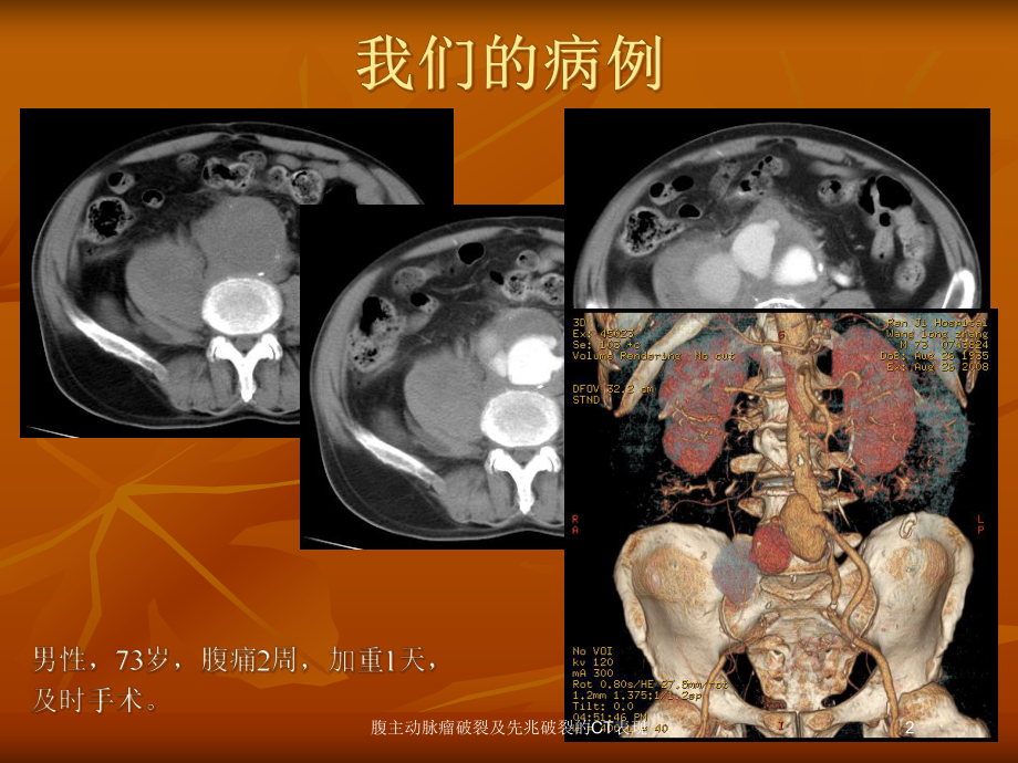 腹主动脉瘤破裂及先兆破裂的CT表现培训课件.ppt_第2页