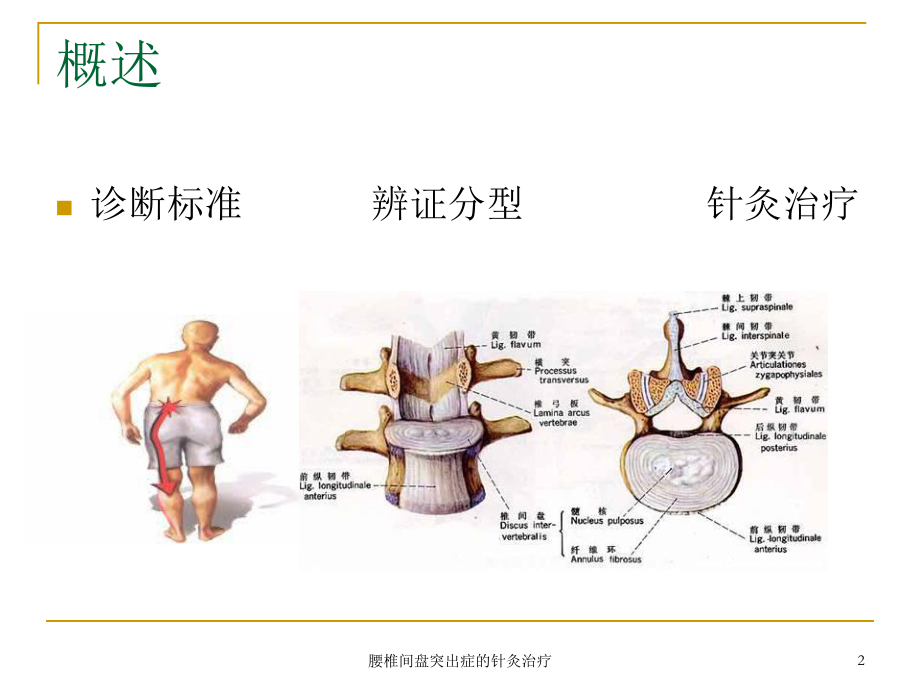 腰椎间盘突出症的针灸治疗培训课件.ppt_第2页