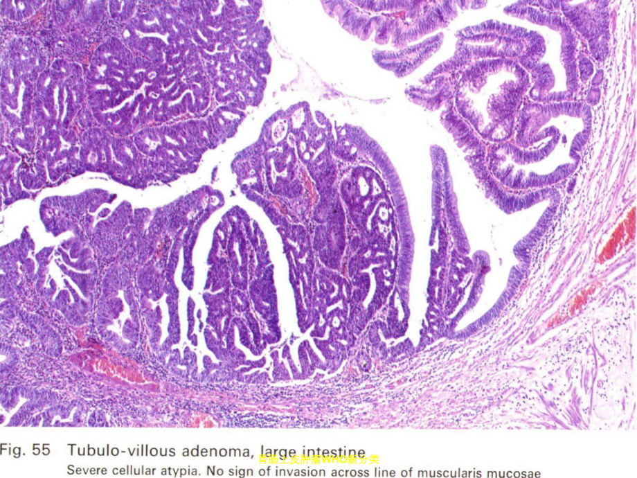 胃肠上皮肿瘤WHO新分类培训课件.ppt_第3页