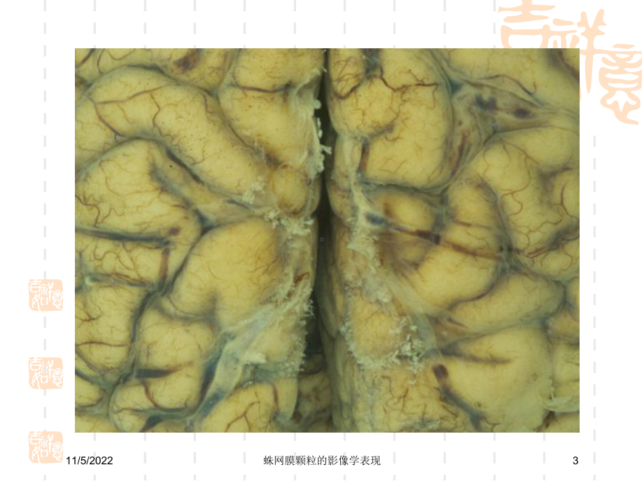 蛛网膜颗粒的影像学表现培训课件.ppt_第3页