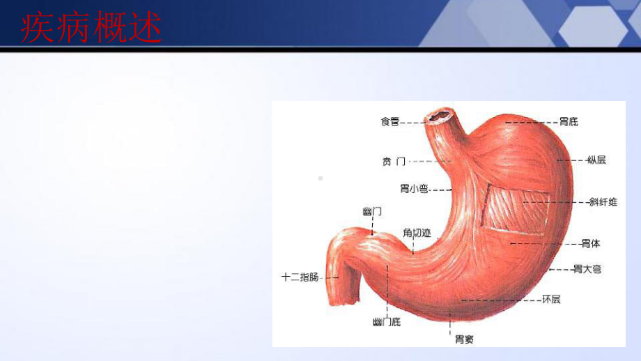 胃癌术后护理课件.ppt_第3页