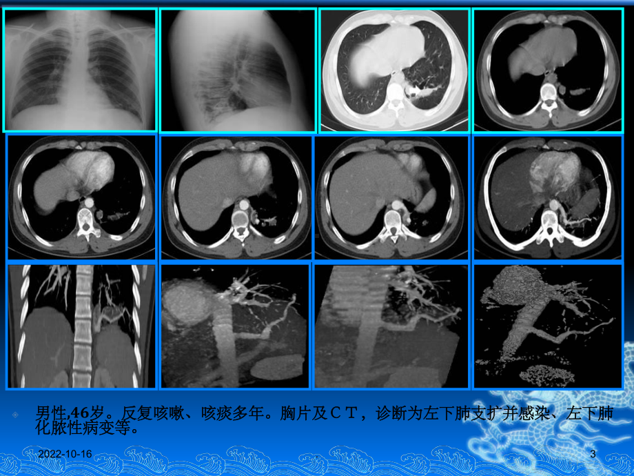 肺隔离症诊断之影像与病理课件.ppt_第3页