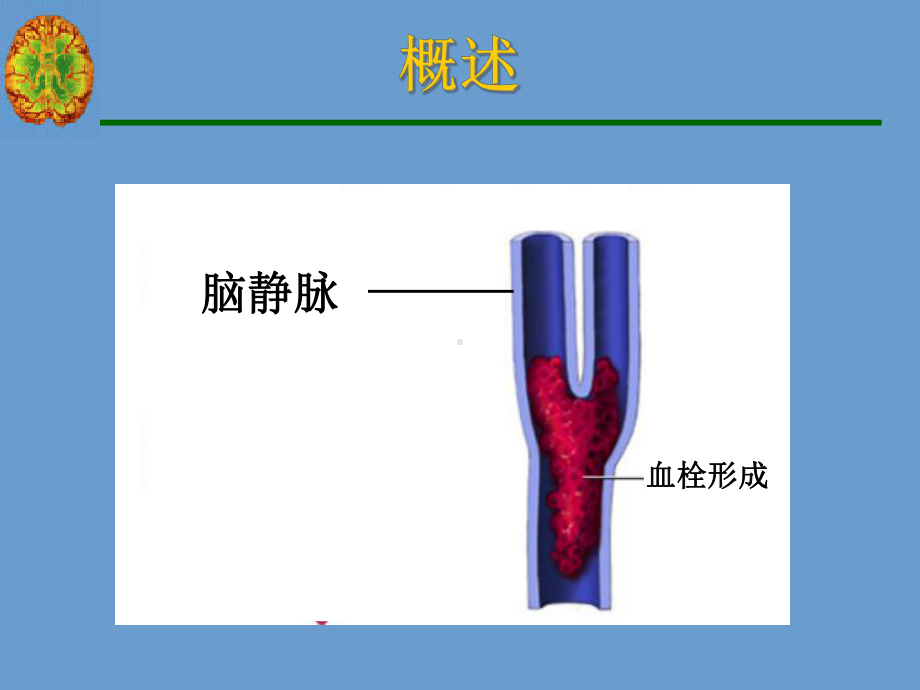 颅内静脉血栓形成课件.ppt_第3页