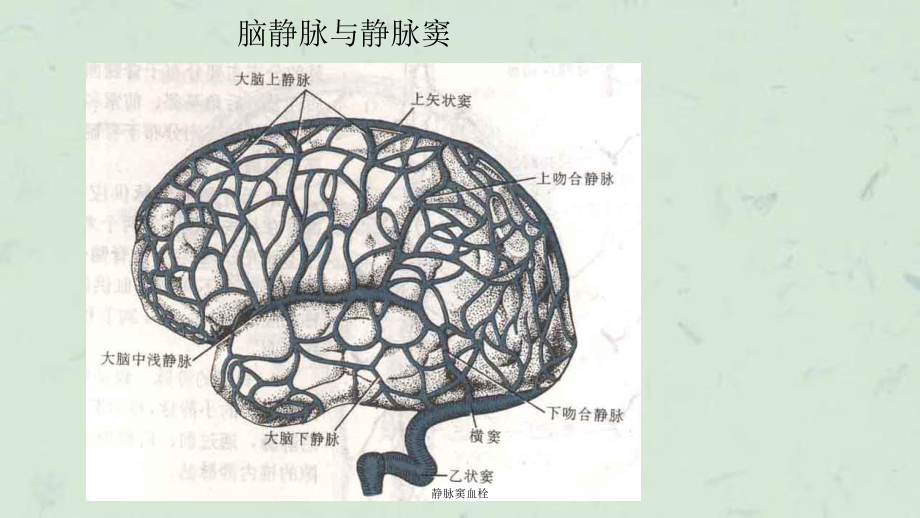 静脉窦血栓课件.ppt_第2页