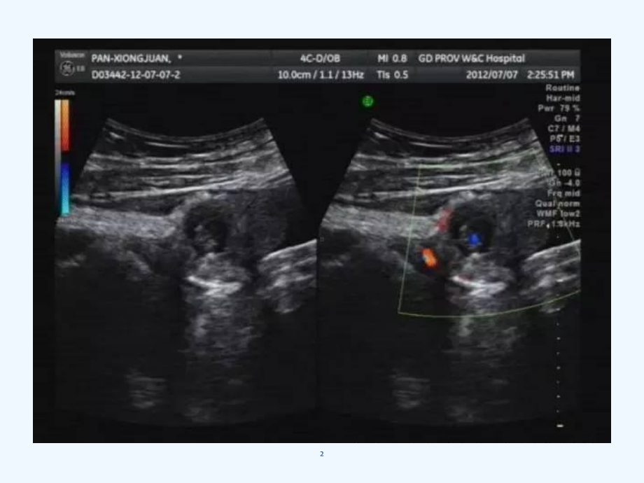 超声医生需要掌握妇科急腹症的临床鉴别诊断副本课件.ppt_第2页