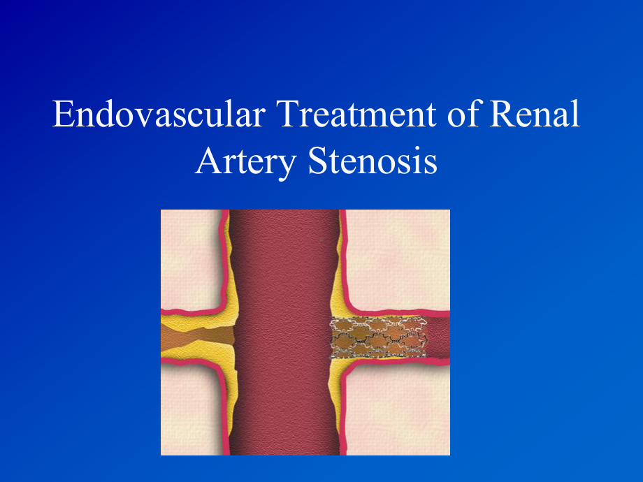 肾动脉支架植入术详解-课件.ppt_第1页