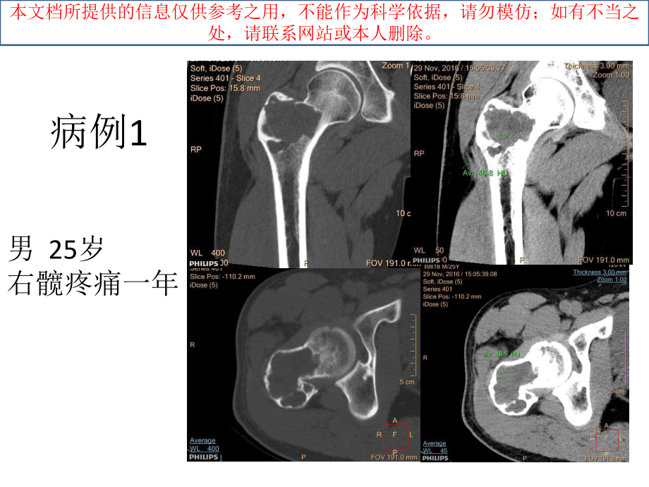 软骨母细胞瘤培训课件.ppt_第1页