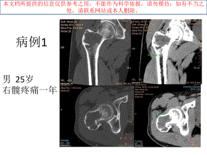 软骨母细胞瘤培训课件.ppt