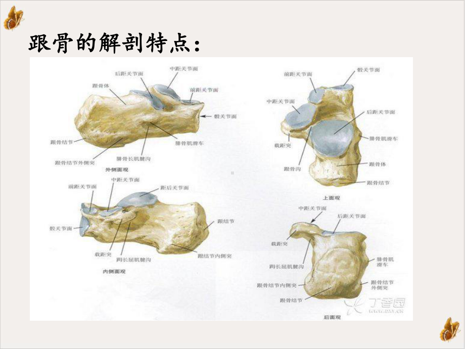 跟骨骨折课件.ppt_第3页