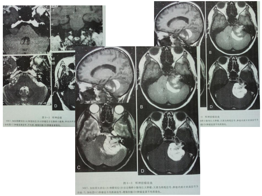 桥小脑角区占位病变课件.ppt_第3页