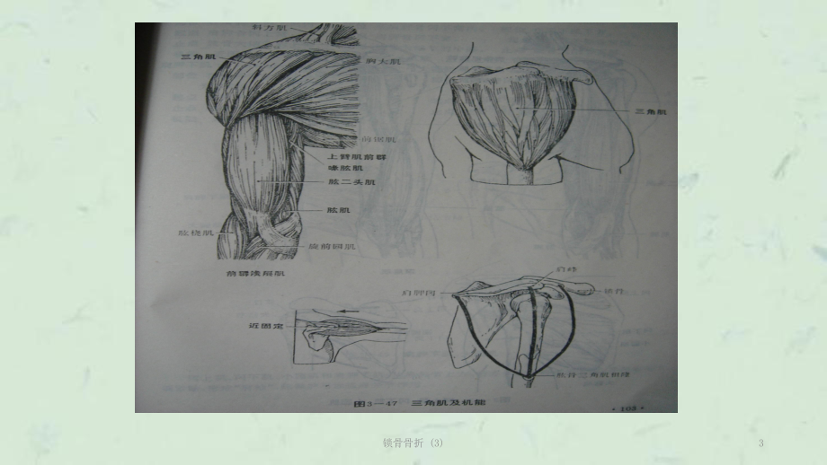 锁骨骨折-课件3.ppt_第3页