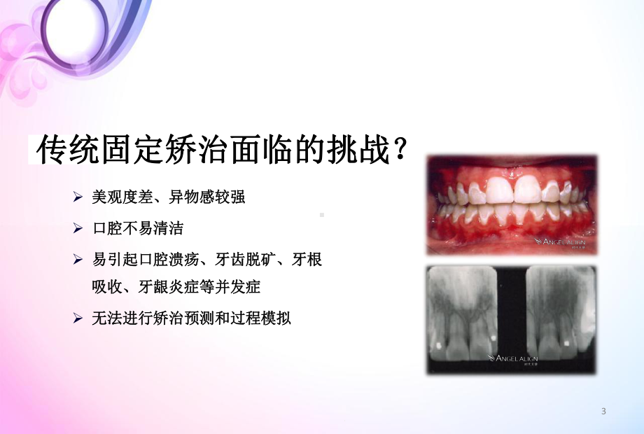 隐形矫正医学课件.ppt_第3页