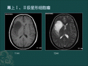 磁共振成像读片题课件.ppt