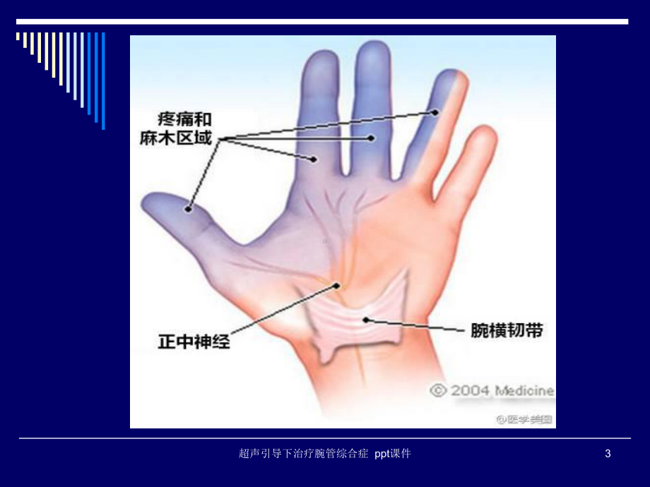 超声引导下治疗腕管综合症-课件.ppt_第3页