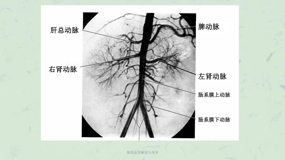 腹部血管解剖与变异课件.ppt_第3页