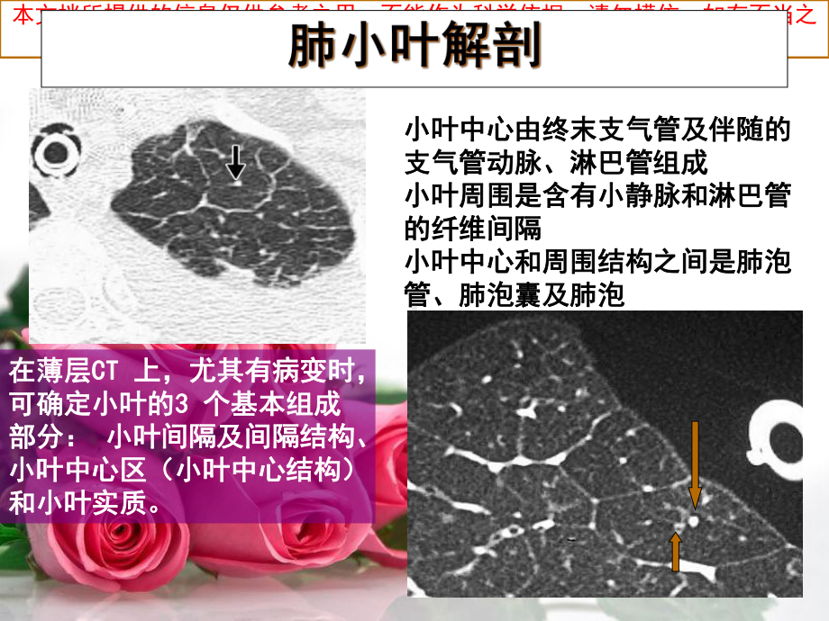 肺间质纤维化的影像表现培训课件.ppt_第3页