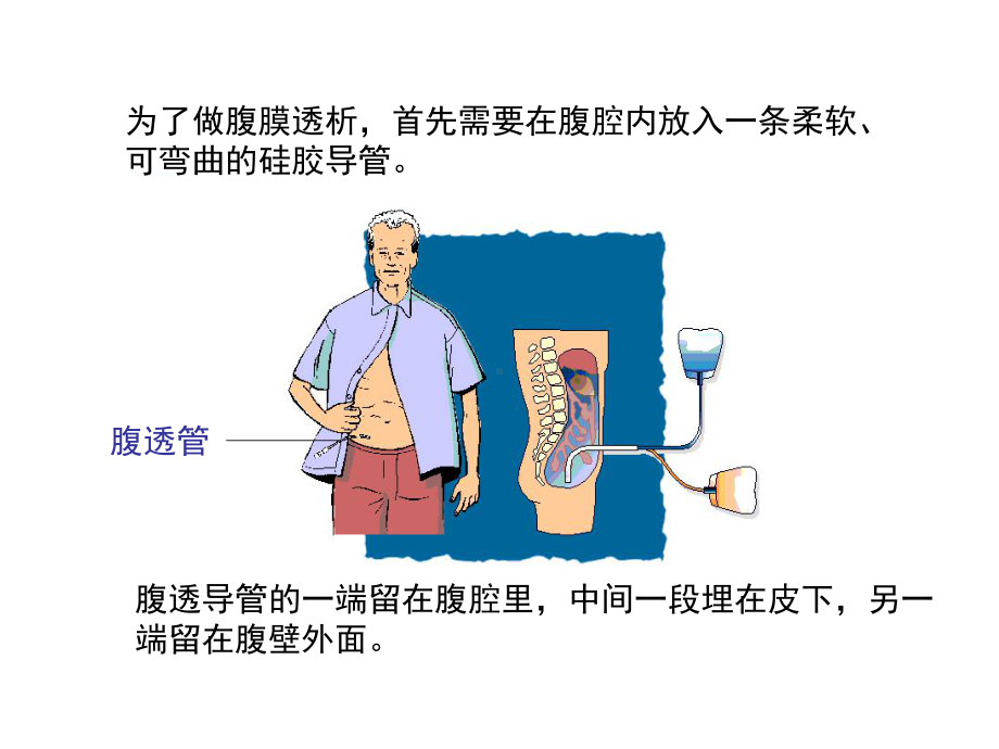 腹膜透析治疗的护理课件.ppt_第3页