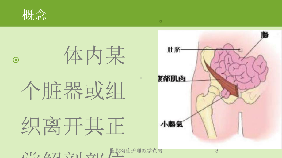 腹股沟疝护理教学查房培训课件.ppt_第3页